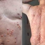 Após pegar Covid, homem desenvolve bolhas por todo o corpo