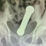 Homem introduz peso de academia de 2 quilos dentro de si e para no hospital
