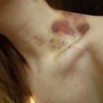 Mulher tem derrame após receber chupão no pescoço durante o s3x0