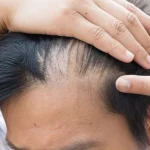 Por que estamos perdendo cabelo? Especialista explica as possíveis causas